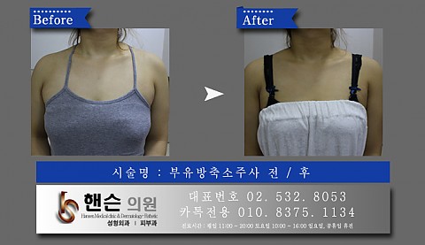 부유방축소주사 전후사진 입니다 