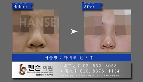바비코 전후사진 입니다 