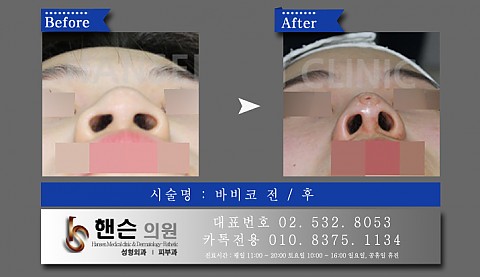 바비코 시술 전후 사진입니다. 