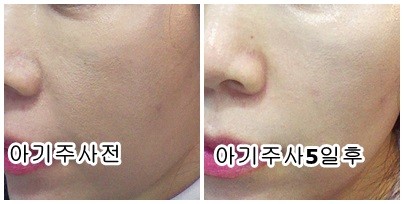 아기주사 효과 대박!!!! 좋아요^^ 