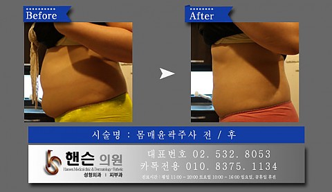 몸매윤곽주사 전후사진입니다 