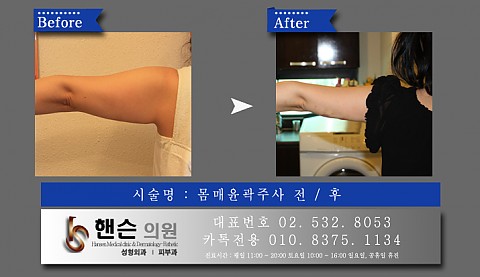 몸매윤곽주사 전후사진입니다 
