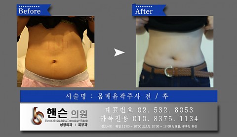 몸매윤곽주사 전후사진입니다 