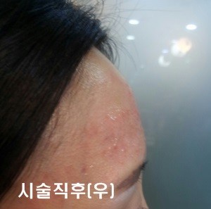 오늘 이마필러하고 왔어요^^ 