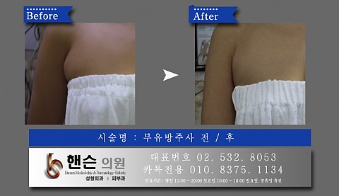 부유방주사 전후사진입니다 