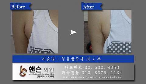 부유방주사 전후사진입니다 