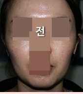 V라인리프팅 받았어요 