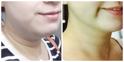 이중턱 2번 맞았어요 ㅋㅋㅋ 