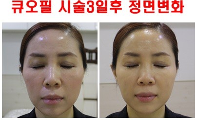지방이식 대체 신개념필러 큐오필 시술에 대하여... 