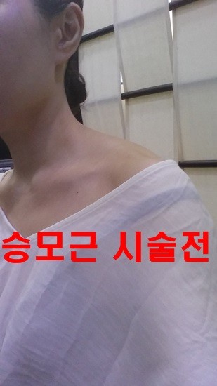 웨찰전에 승모근 보톡스받았어요~~ 