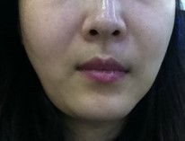 윤곽주사랑 광폭주사로 갸름해지고 있어요~ 