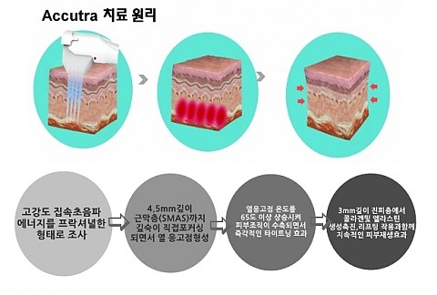 리프팅레이저_아큐트라,울쎄라,더블로리프팅의 원리 