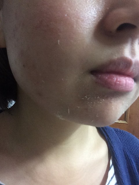 알라딘필링 여드름흉터때문에 받았어요 