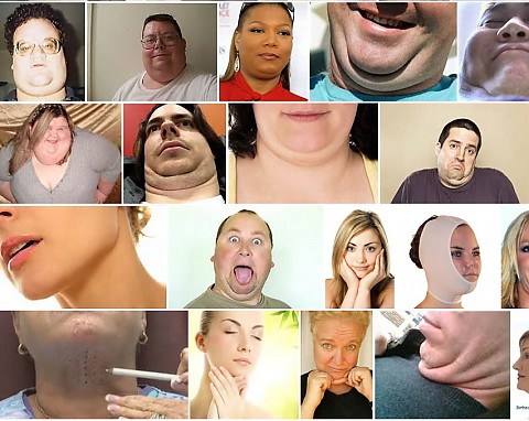 Doulble Chin Injection_international clinic for expatriates in Korea. 