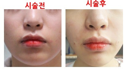 리텐스 필러 후기입니다~~^^ 