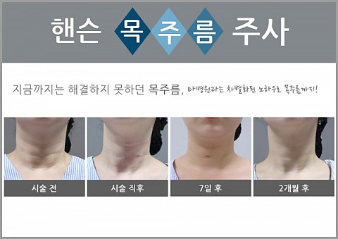 핸슨의 HOT 시술들 