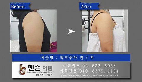 팻건주사(지방분해주사) 전후사진입니다 