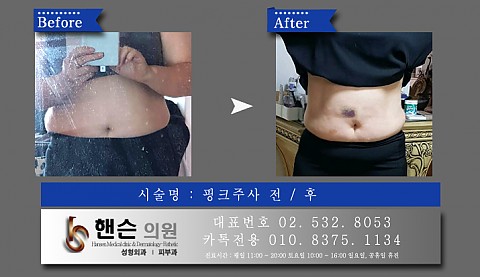 팻건주사(복부) 전후사진입니다 