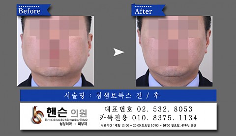 남자 침샘보톡스 전후사진입니다 