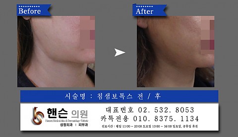 침샘보톡스 전후사진입니다 