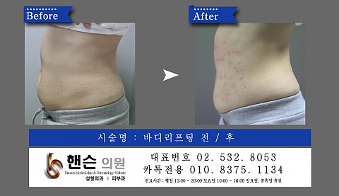 바디리프팅 전후사진입니다. 