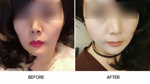 볼필러 전후사진입니다. 
