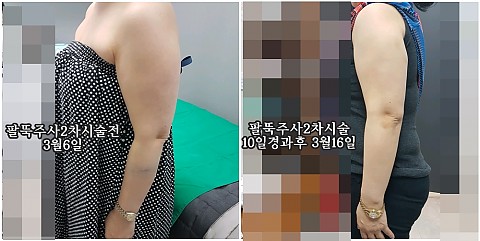 팻건주사 팔뚝에 2번 맞은 후기올려볼께요 