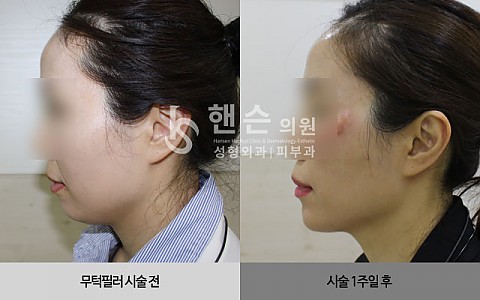 무턱필러 전후사진 입니다. 