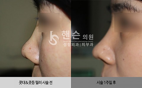 코필러 전후사진입니다. 