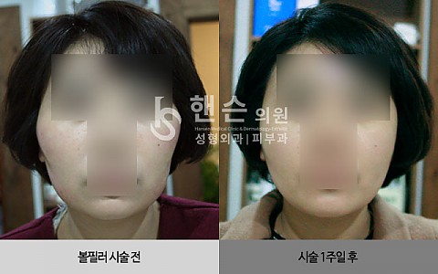 볼필러 전후사진 입니다. 