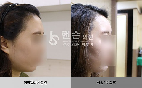 이마필러 전후사진 입니다. 