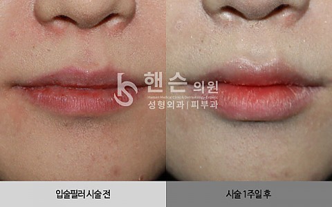 입술필러 전후사진 입니다. 