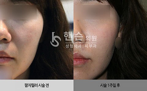 팔자필러 전후사진 입니다. 