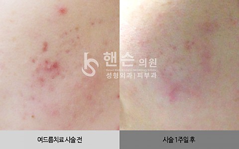 여드름치료 전후사진 입니다. 