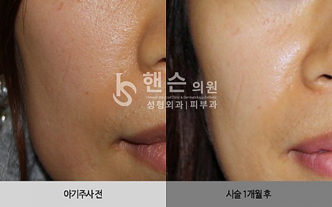 아기주사 전후사진 입니다. 