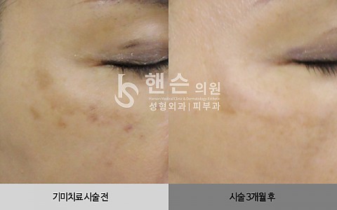 기미치료 전후사진 입니다. 
