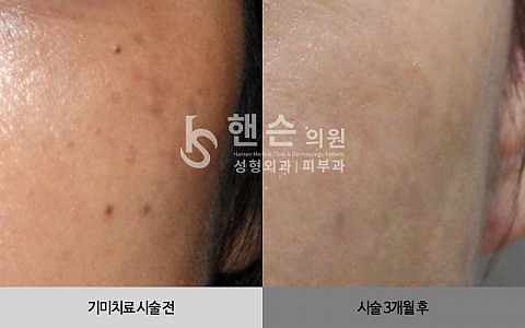 기미잡티치료 전후사진 입니다. 