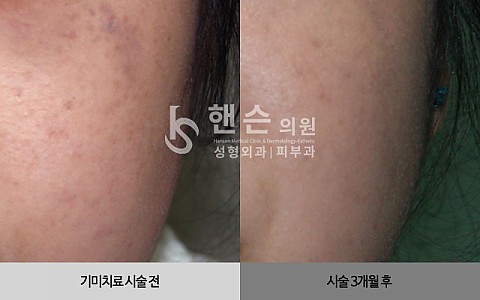 기미잡티치료 전후사진 입니다. 