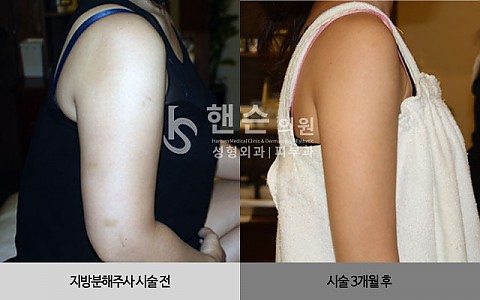 팻건주사 전후사진입니다. 