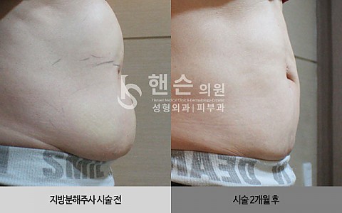 팻건주사 전후사진입니다. 