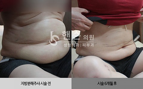 팻건주사 전후사진입니다. 