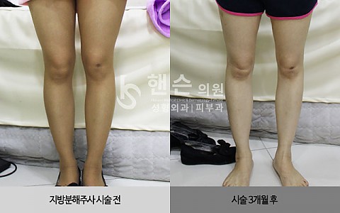 팻건주사 전후사진입니다. 
