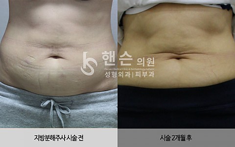 팻건주사 전후사진입니다. 