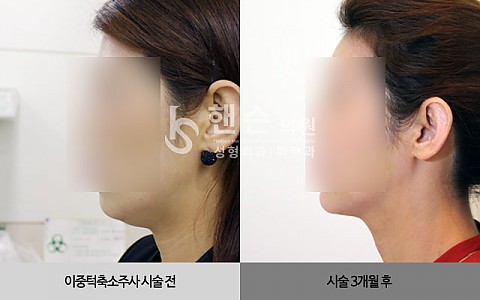 이중턱주사 전후사진입니다 