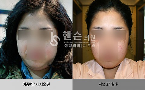 이중턱주사 전후사진입니다 