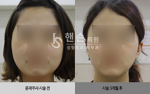 윤곽주사 전후사진 입니다. 
