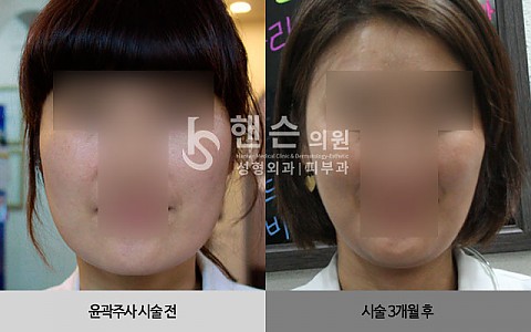 윤곽주사 전후사진 입니다. 