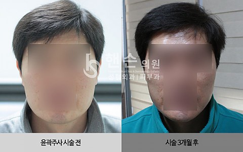 윤곽주사 전후사진 입니다. 