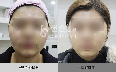 윤곽주사 전후사진 입니다. 