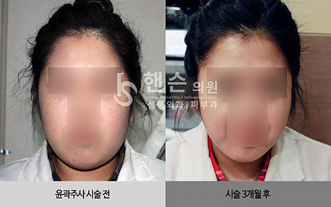 윤곽주사 전후사진 입니다. 